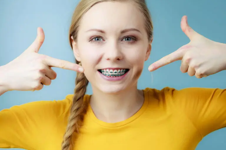 A dental model displays teeth with rhodium metal braces on both the upper and lower rows, crafted by a skilled orthodontist in Austin