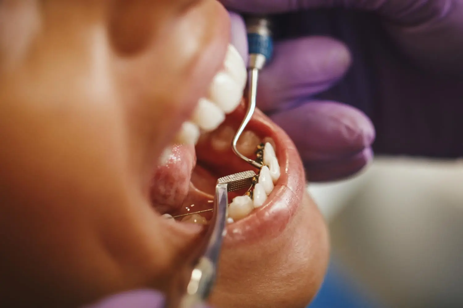 Close-up of a dentist from Best Orthodontics wearing purple gloves, meticulously performing a dental procedure on a patient's teeth using specialized tools.