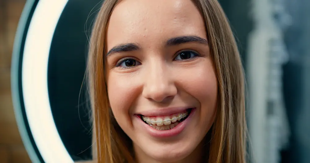 Best Orthodontics Clear braces aligning teeth seamlessly during an orthodontic treatment journey