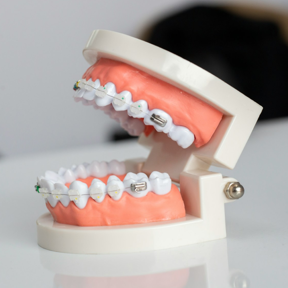 Different options detailing orthodontic insurance coverage options and costs.