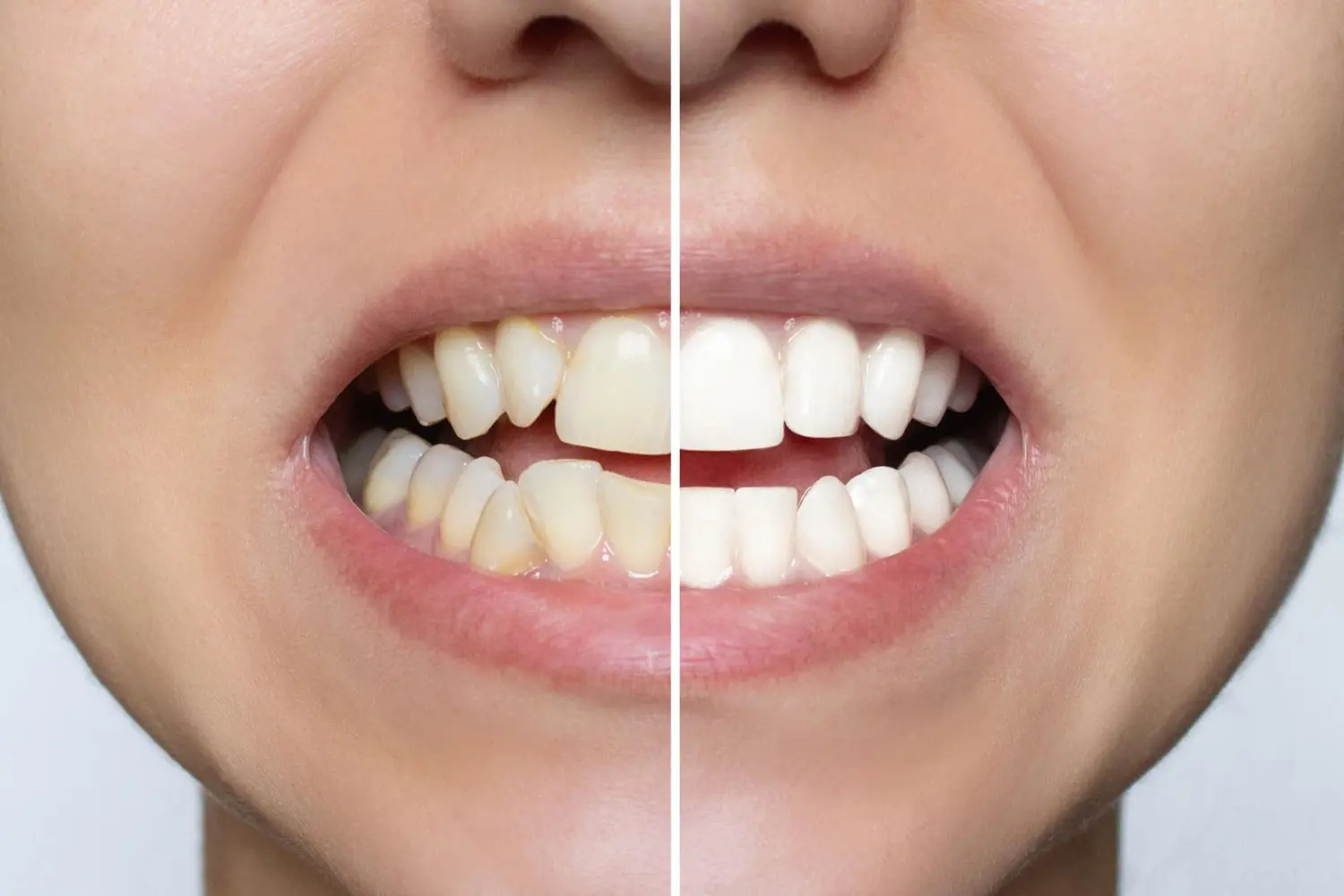 Split image of a person's mouth showing teeth before (left, yellowish) and after (right, whitened) dental whitening treatment—highlighting the best orthodontics for achieving a radiant smile.