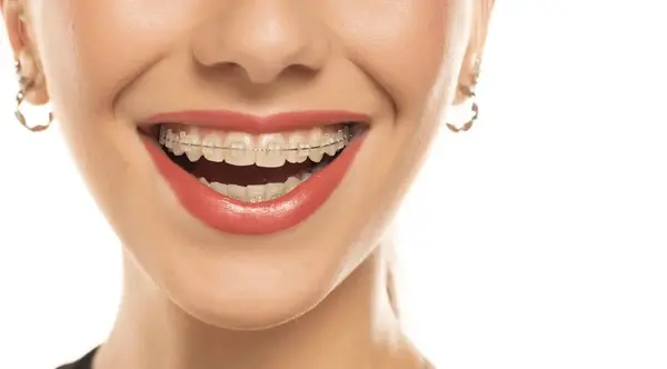 Close-up of a smiling person with red lipstick, proudly highlighting their clear braces in Austin