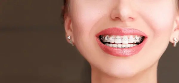 A person smiling broadly, their teeth adorned with a mix of traditional and ceramic braces in Austin