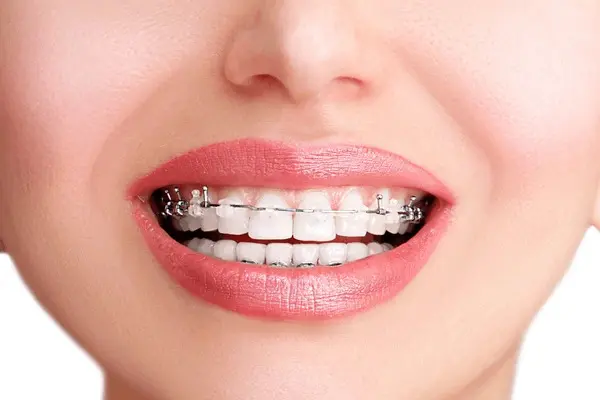 Close-up of a smiling person showcasing ceramic braces on their teeth in Houston