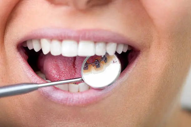 Close-up of a person with lingual braces, showing teeth and mouth. A dental mirror reflects the hidden beauty of these braces in Houston