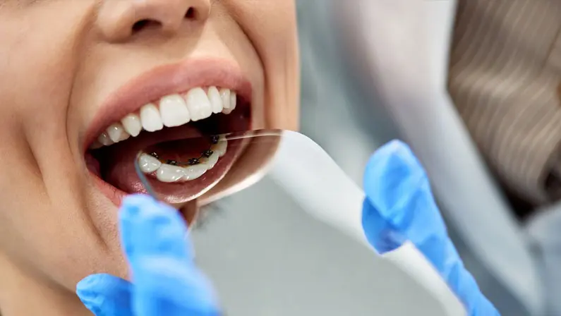 Close-up of a person with lingual braces having their teeth examined with a dental mirror, held by someone wearing blue gloves in Austin and Houston