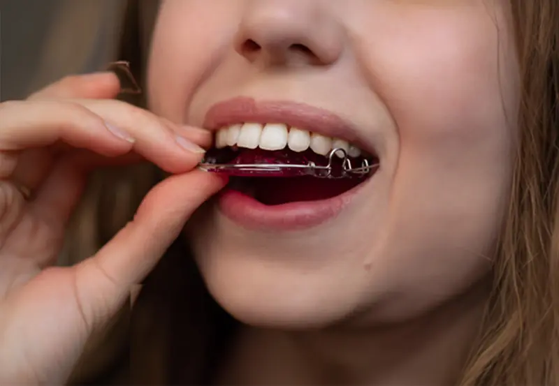Women wearing a teeth retainer